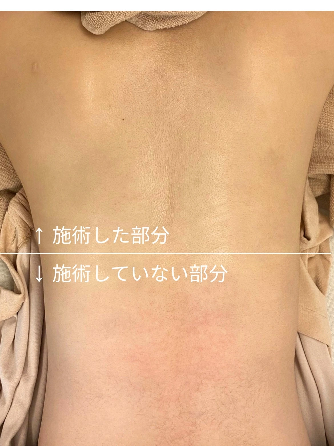 背中の施術、当日のビフォーアフター画像