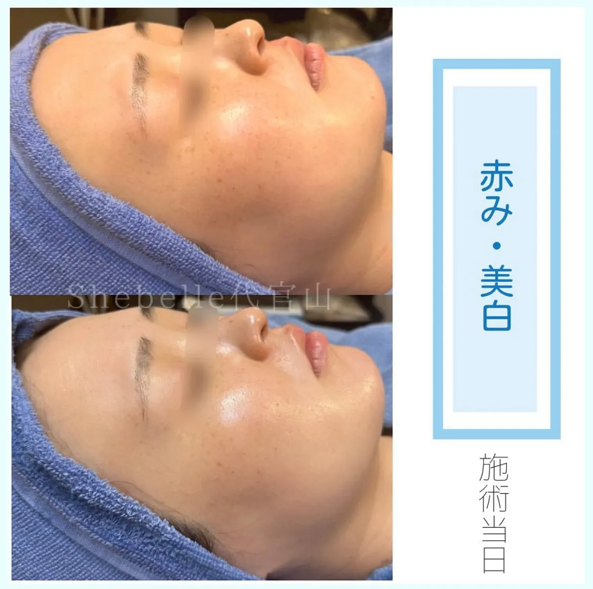 赤み・美白に対するケアのビフォーアフター