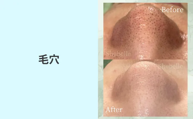毛穴の症例写真①
