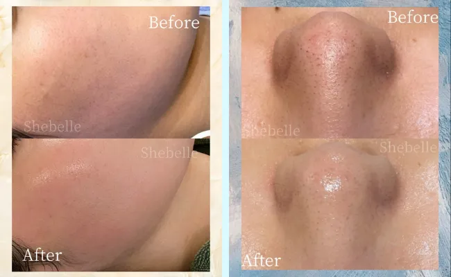 毛穴の症例写真②