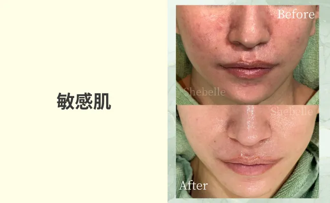 敏感肌の症例写真①