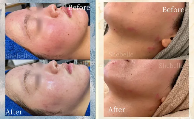 敏感肌の症例写真②