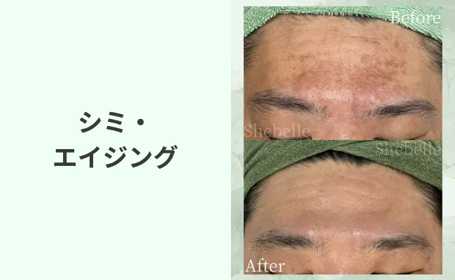 シミ・エイジングの症例写真①