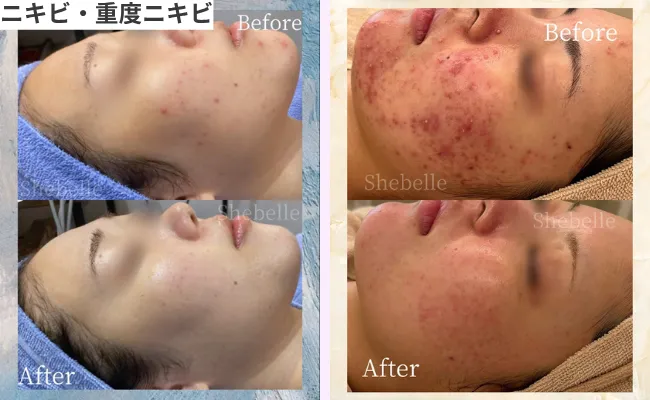 ニキビ・重度ニキビの施術症例①