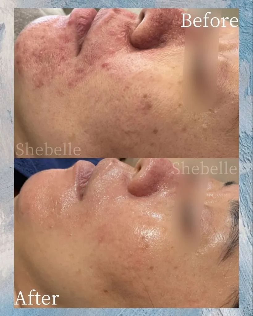 皮膚科の薬(イソトレチノイン)を併用しながらの炎症ニキビの症例