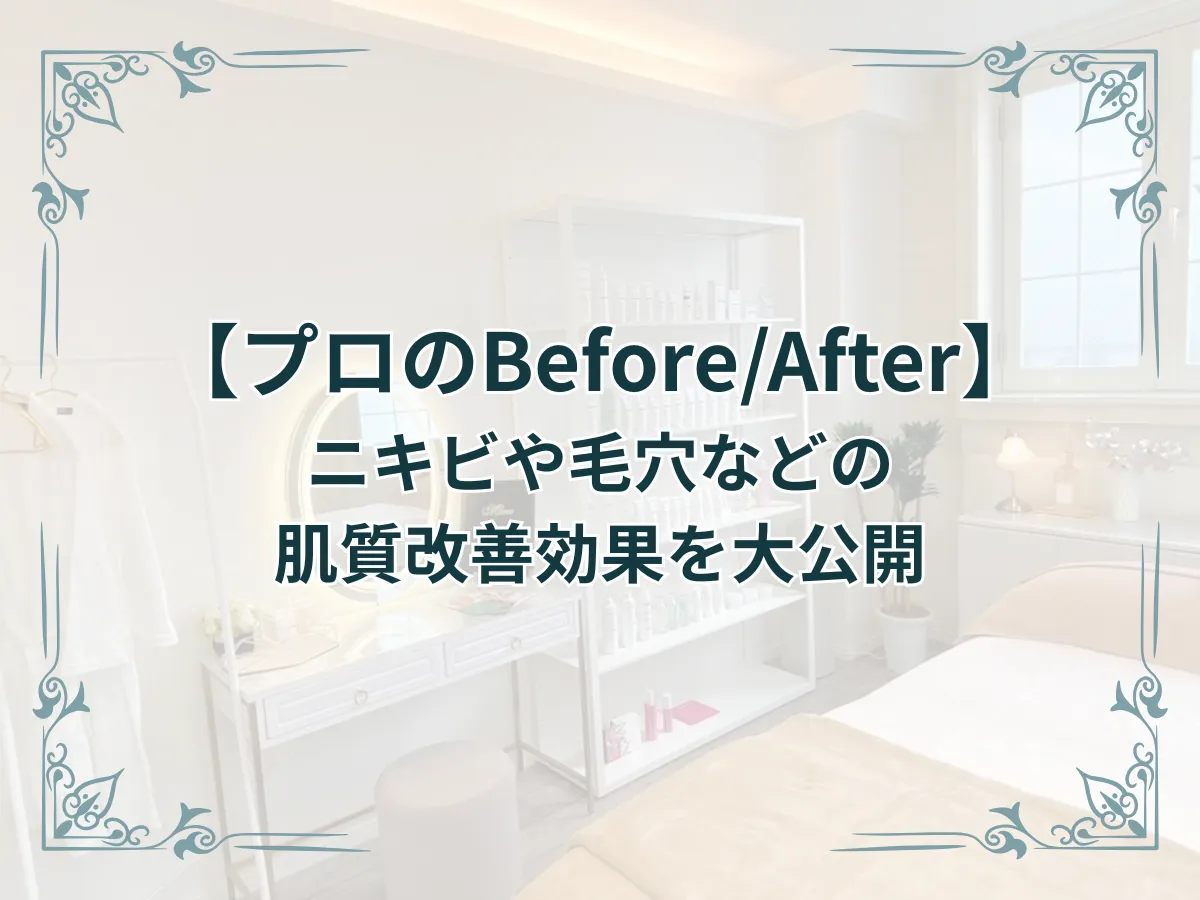 【プロのBefore/After】ニキビや毛穴などの肌質改善効果を大公開　のアイキャッチ