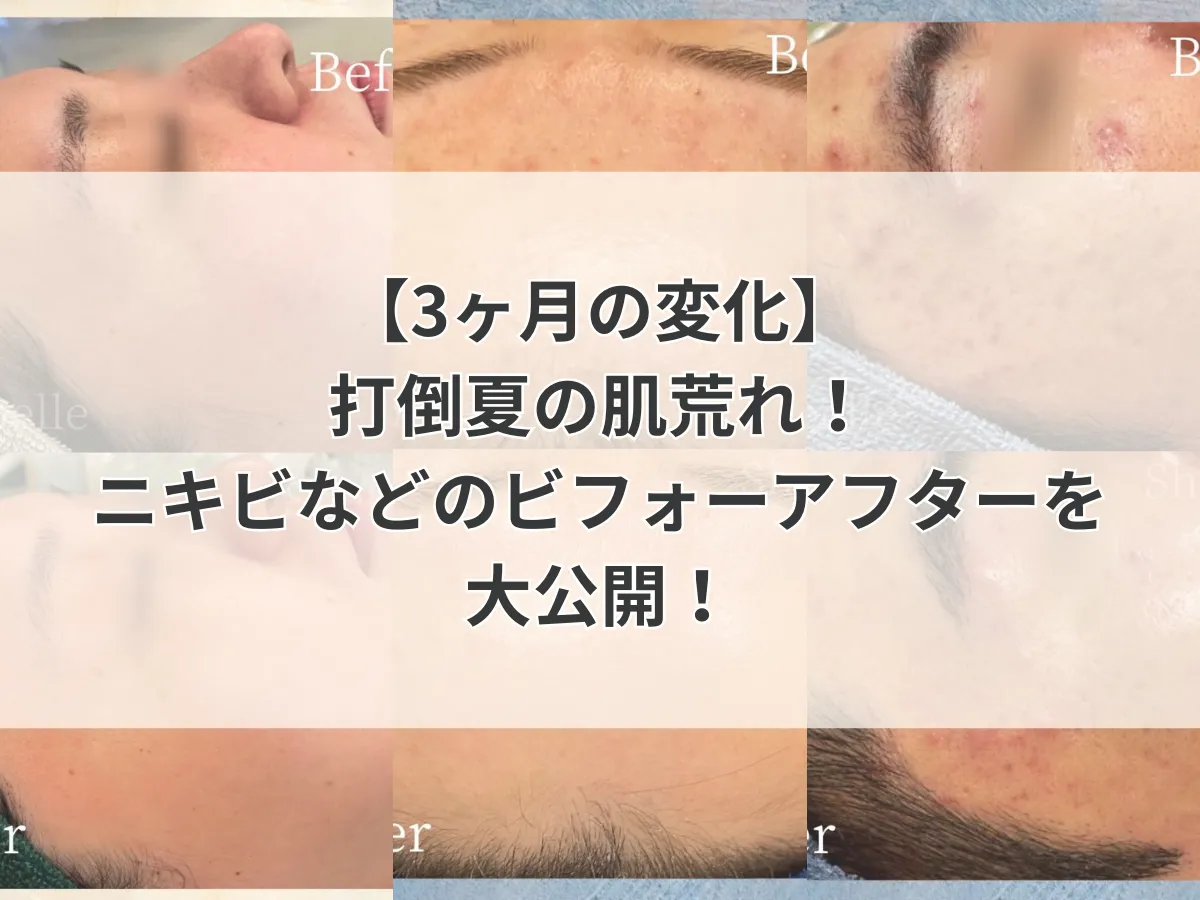 【3ヶ月の変化】打倒夏の肌荒れ！ニキビなどのビフォーアフターを大公開！